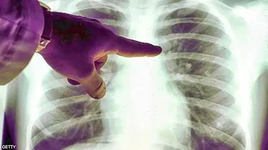 هل ظهر "مرض تنفسي جديد" في الصين؟ منظمة الصحة العالمية توضح